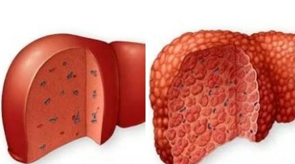 Жировой гепатоз 2 степени. Ожирение печени у женщин после 60. Причины жирового перерождения печени. Жировой гепатоз печени. Жировой гепатоз печени лечится.