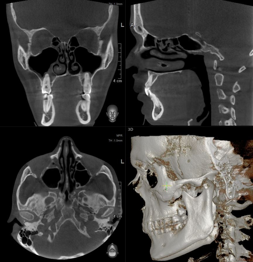Компьютерная томография двух челюстей и ВНЧС