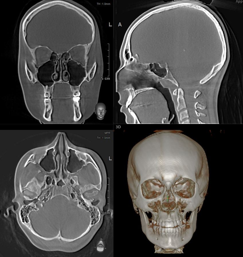 КТ костей лицевого и мозгового отдела черепа .jpg