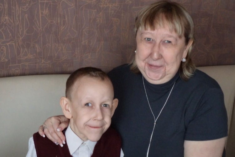 8-летний старик и 19-летняя бабушка с синдромом вялой кожи. Видео