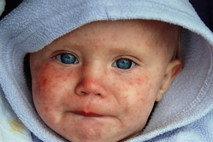 В Балаково выявлены 24 случая заболевания корью. Как обезопасить себя и ...