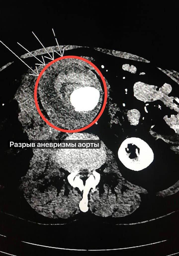 Жуковские врачи спасли мужчину с разрывом брюшной аорты