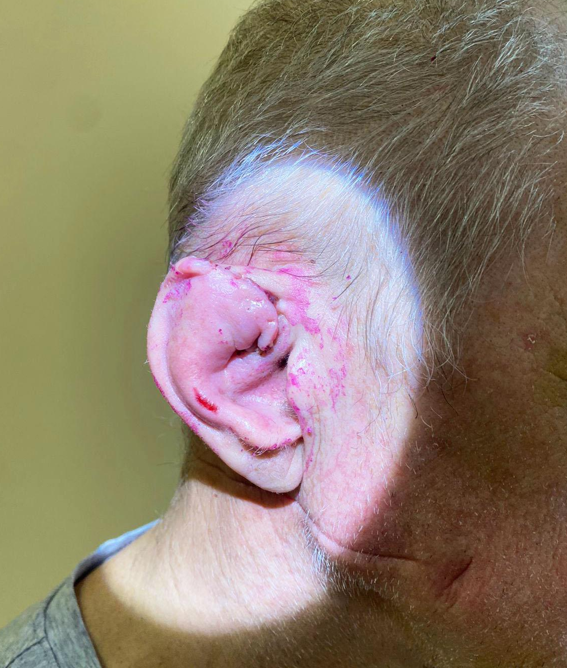 Долгопрудненские отоларингологи восстановили пациенту оторванное ухо