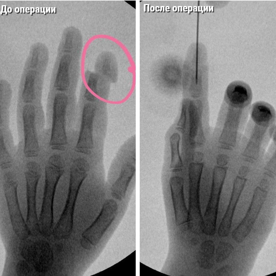Стали известны подробности, как хирургам удалось спасти перерубленный палец девочки