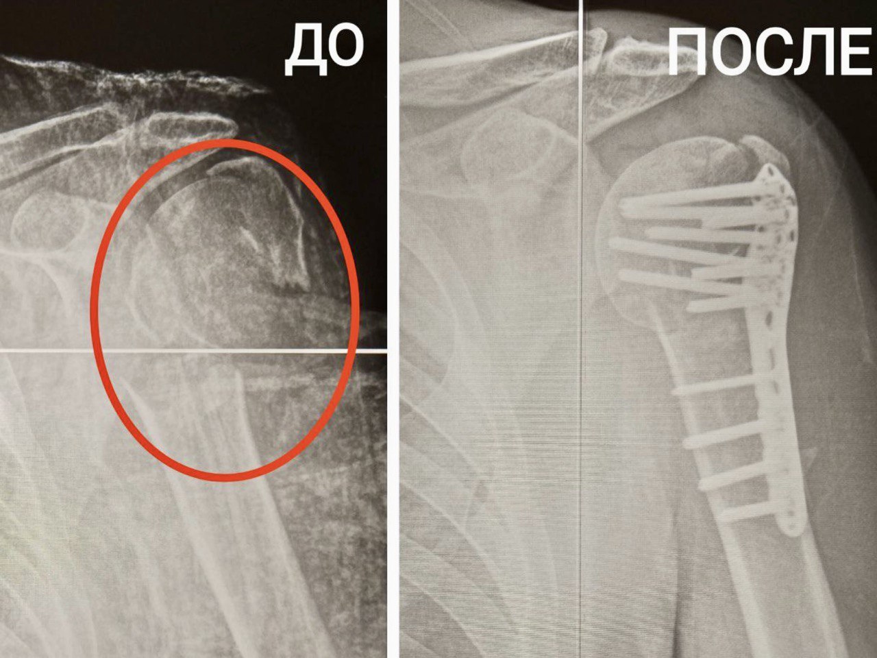 Хирурги из Балашихи по крупицам собрали плечо пациенту, упавшему со  стремянки | REGIONS.RU / Балашиха