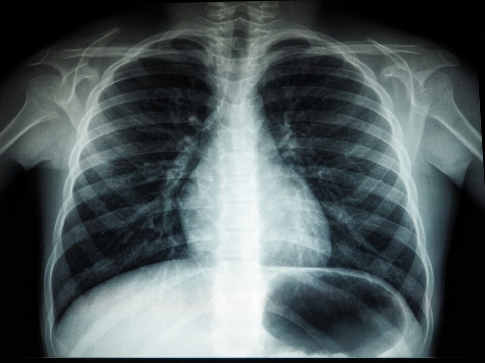 В подмосковных больницах заменили еще 4 устаревших рентген-аппарата