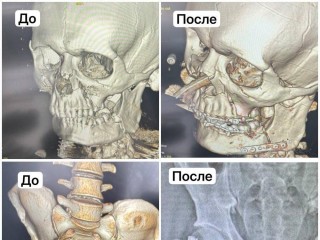 Спасли жизнь: раменские врачи прооперировали мужчину с девятью переломами после ДТП