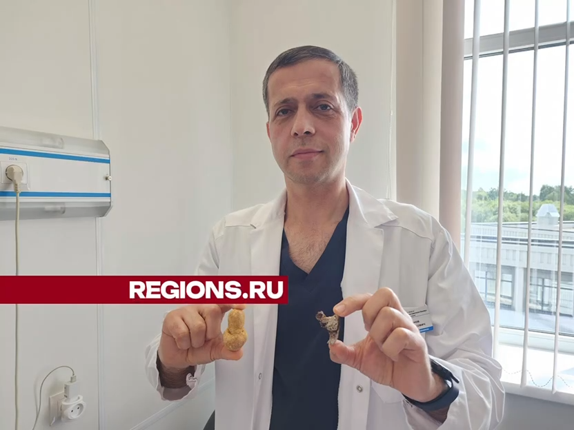 Заведующий урологическим отделением больницы в Истре показал коллекцию камней, извлеченных из пациентов