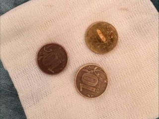 «Крысиный зуб» помог врачам Центра Рошаля извлечь три монеты из желудка девочки