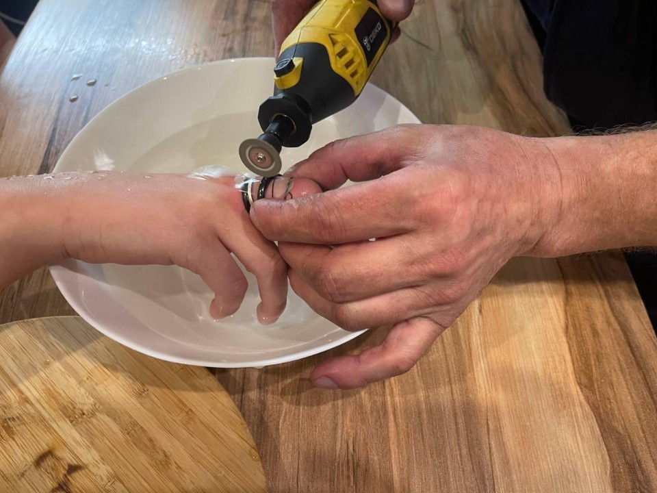 Спасатели сняли три тесных кольца с пальца девочки в Солнечногорске