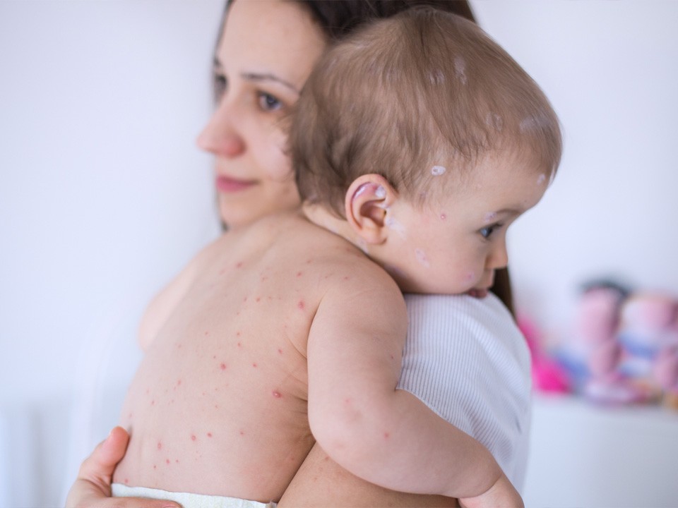 Врач-инфекционист Мескина рассказала, для кого ветрянка крайне опасна
