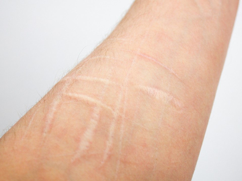 Что скрывается за шрамами: психиатры рассказали об опасности модного у подростков селфхарма