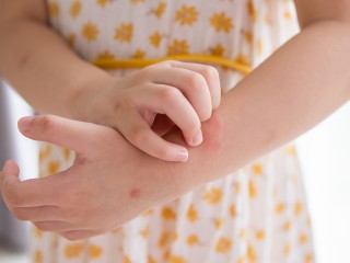 Видновский врач объяснила, как отличить крапивницу от аллергии