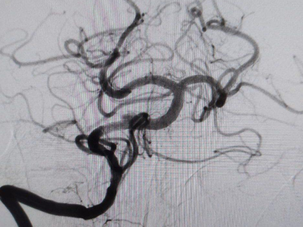 Зарайские врачи предупредили о невидимой угрозе «ночных инсультов»
