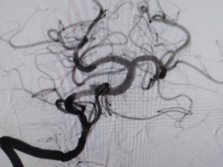 Зарайские врачи предупредили о невидимой угрозе «ночных инсультов»