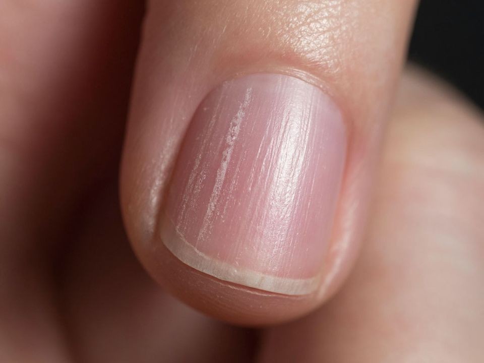 Ногти в полосочку: когда ребристость — это норма, а когда — серьезный сигнал от организма