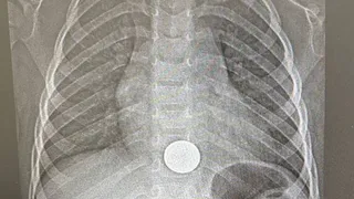 В Нижнекамске врачи спасли трёхлетнего малыша, проглотившего монету