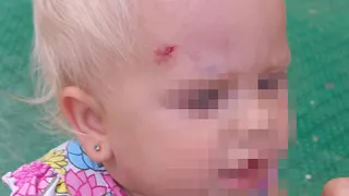 В Рязани на детской площадке на улице Семчинской ребенок едва не лишился глаза