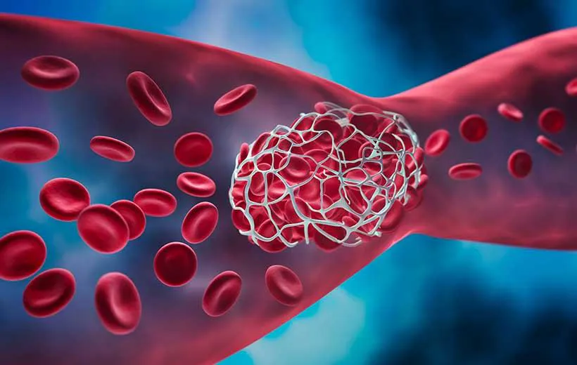 Назван симптом тромбоза, на который никто не обращает внимание