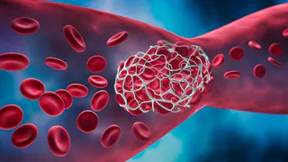 Назван симптом тромбоза, на который никто не обращает внимание