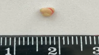 Врачи Владимирской ОДКБ удалили камень из слюнного протока у ребёнка