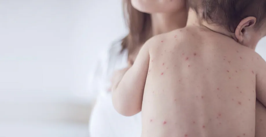 Минздрав Пензы назвал основные симптомы кори