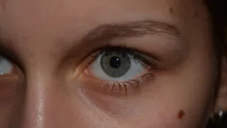 Проверьте свои родинки: рязанцев пригласили на диагностику меланомы