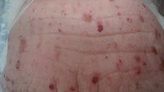 Рязанец получил ожоги, предотвращая взрыв газа во время пожара