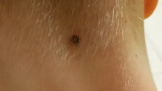 Парк в Магнитогорске стал опасным для детей из-за клещей