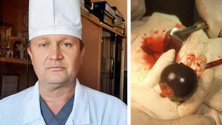 Тазобедренный сустав жителя Пензы попал в музей медицинского института