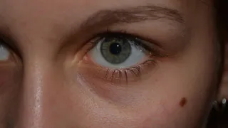 У четырех рязанцев подозревают рак кожи из-за родинок