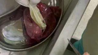 В Рязанской БСМП из печени женщины врачи удалили крупного ленточного червя