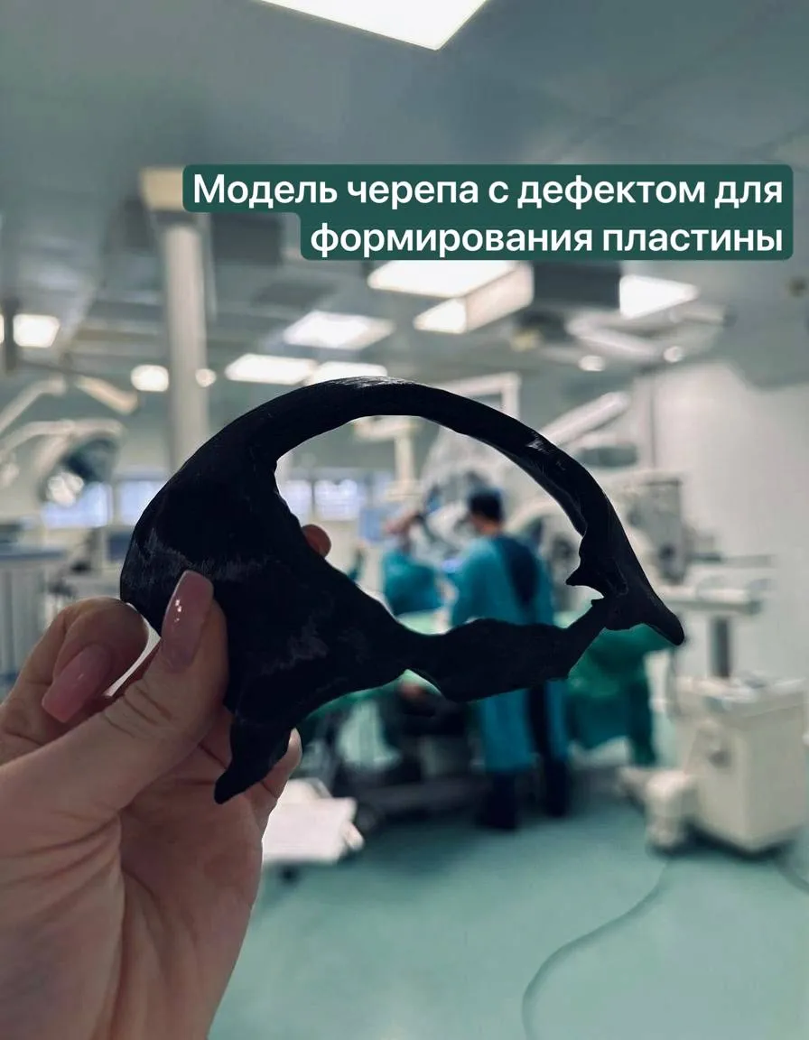 Татарстанские врачи восстановили бойцу СВО лоб с помощью 3D-технологий