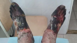 Первый случай  обморожения: дошло даже до ампутации!