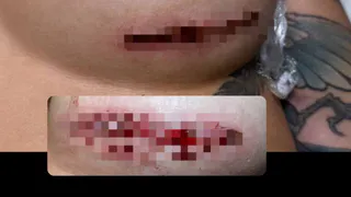 Участница проекта «Дом-2» показала шрамы после рязанских косметологов