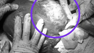 В РКБ Татарстана провели уникальную операцию: миому удалили прямо во время кесарева сечения