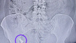 Врачи спасли жительницу Казани, проглотившую зубной протез