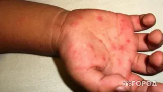 В соседнем регионе у воспитанника детсада педиатр заподозрила Коксаки