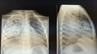 Владимирские врачи спасли малыша с тяжелой формой пневмонии