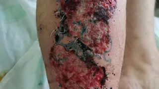 В Рязани парень получил ожог, попытавшись избавиться от тату