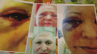 Шокирующее фото: москвичка лишилась зрения после популярной процедуры