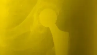 Рязанские врачи вернули женщине длину конечности после неправильного лечения