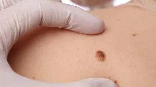 Медик опроверг распространенный миф насчет родинок