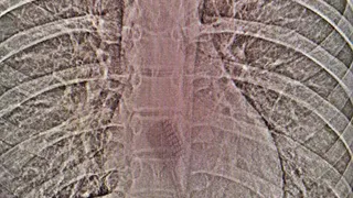 Невероятный случай в КДМЦ Челнов: врачи извлекли зубную щётку из желудка подростка