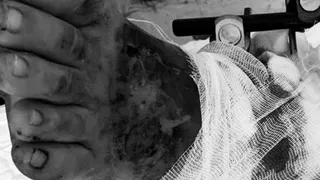 В Рязани врачи пришили мужчине отрезанную ногу