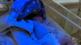 Врачи рассказали о состоянии новорожденной с тяжелой гемолитической болезнью