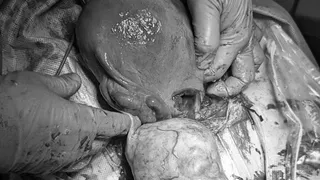 Уникальный случай: в Татарстане беременной женщине удалили 23 см. опухоль