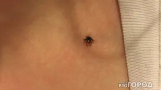 В Коми зарегистрировали первый укус клеща: оказана медицинская помощь