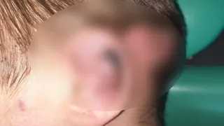 Врачи Владимирской ОДКБ спасли ухо 13-летнему мальчику после аварии