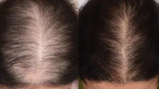 Что делать, если у пожилых людей начали выпадать волосы